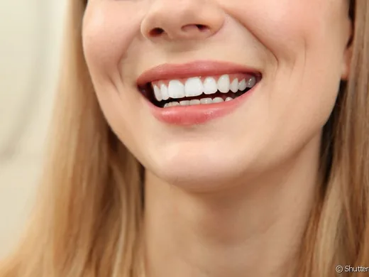 Sorriso com dentes claros após clareamento dental