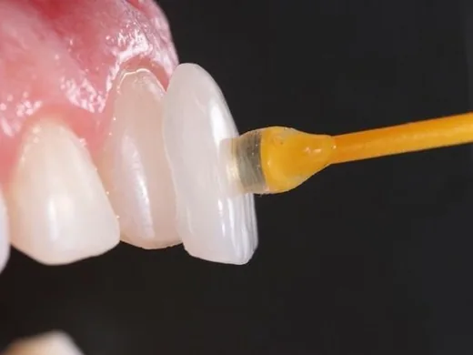 Aplicação de uma faceta de porcelana sobre o dente