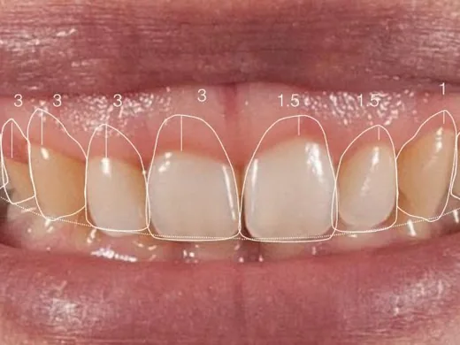 Medição do contorno da gengiva com régua periodontal