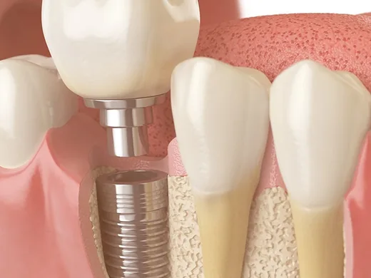 Ilustração de implante dentário com pino de titânio fixado no osso