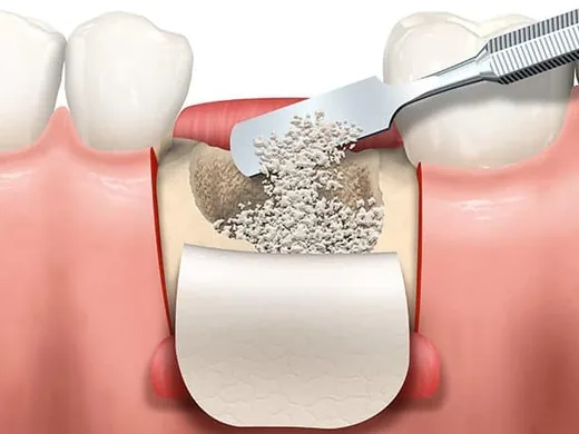 Ilustração de enxerto ósseo sendo aplicado entre os dentes