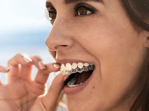 Pessoa encaixando um alinhador ortodôntico transparente nos dentes