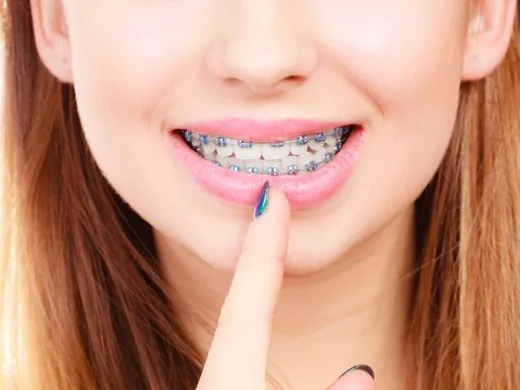 Pessoa apontando para o aparelho fixo convencional nos dentes