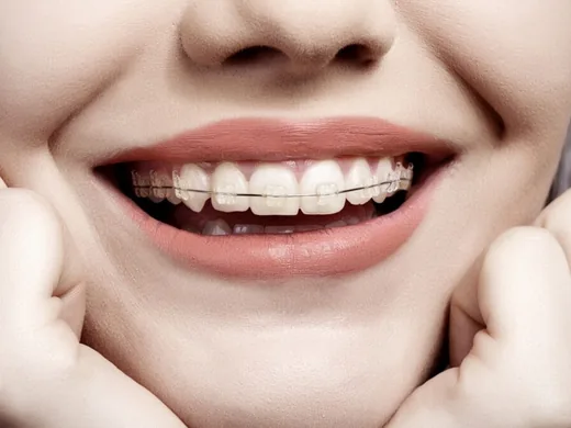 Sorriso com aparelho ortodôntico estético de bráquetes claros